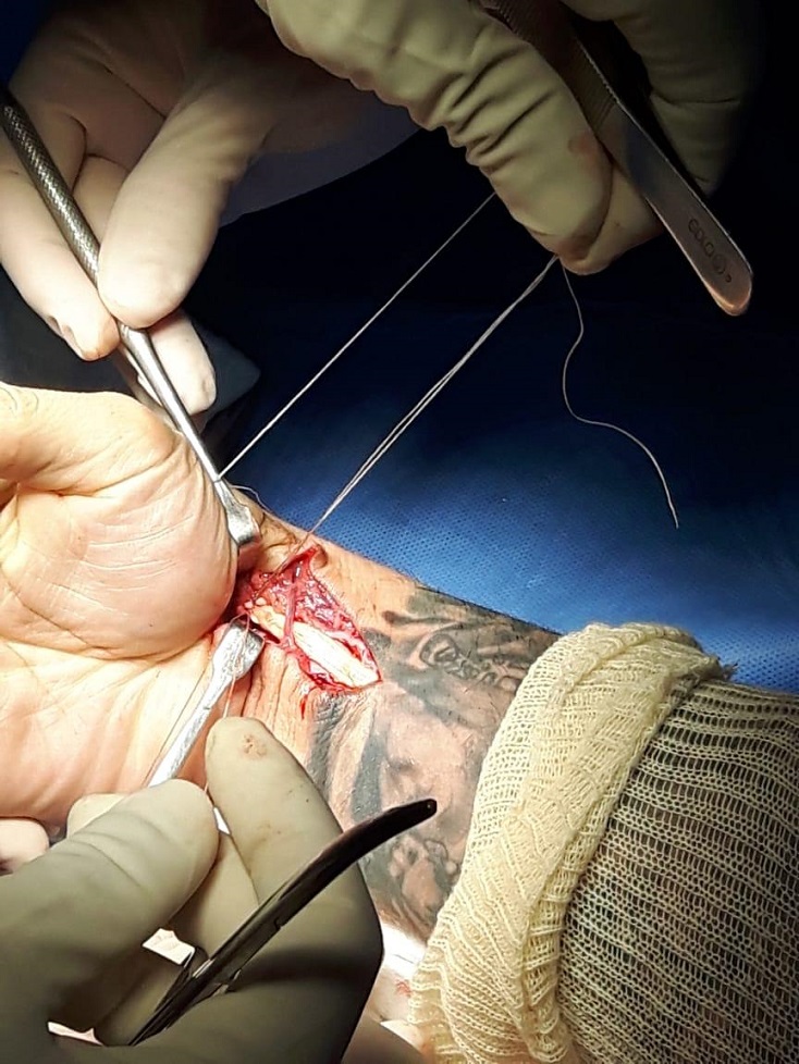 patricky pitbull cirurgia2