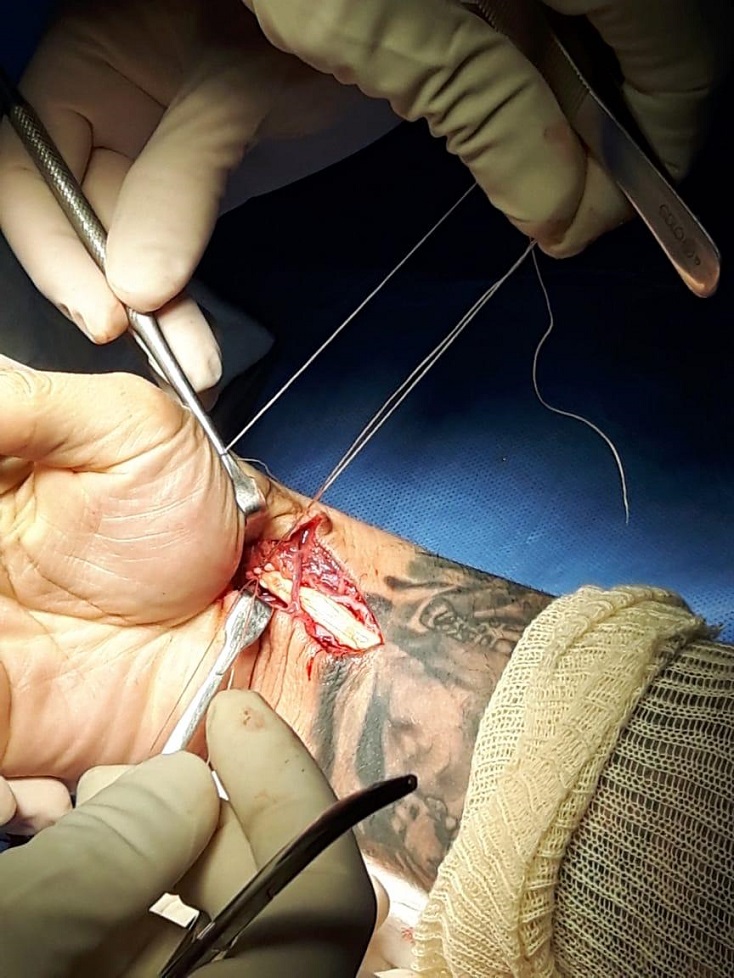 patricky pitbull cirurgia3