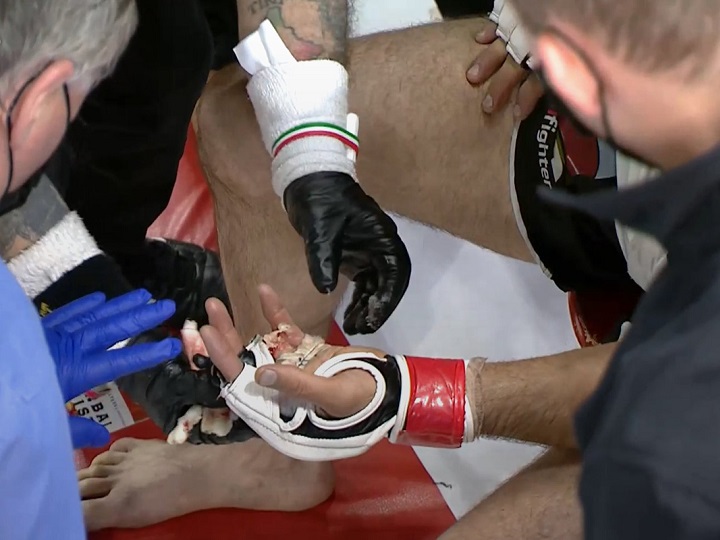 IMAGENS FORTES: lutador canadense perde um dedo após receber chute em luta de MMA nos Estados Unidos; assista ao momento chocante