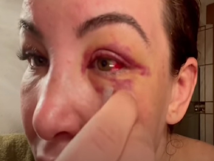 Miesha Tate retira pontos do rosto após ‘castigo’ de Ketlen