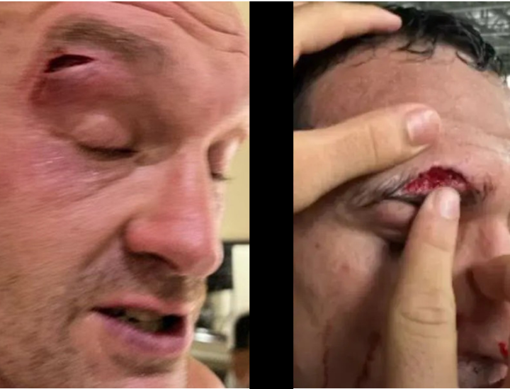Tyson Fury sofreu uma lesão semelhante a de Charles do Bronx as vésperas do UFC 294 em novembro (Foto: Reproduçãó)